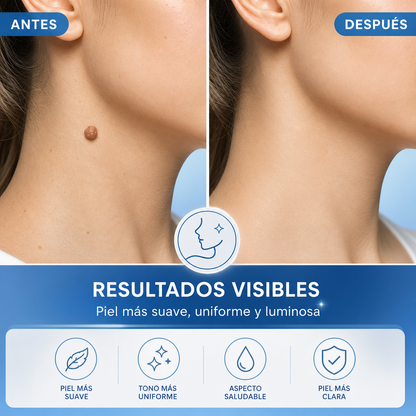 Kit de eliminación de verrugas